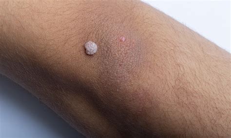 Mole Vs Wart Spotting The Key Differences Biocleve