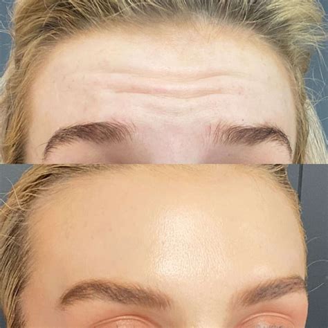 Best Anti Wrinkle Injections Clinic In Brisbane Elinay Cosmetic