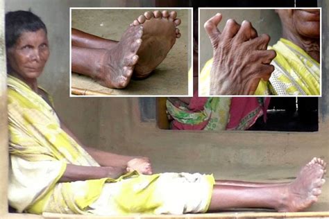 woman born with an incredible 19 toes and 12 fingers is branded a witch in india newscabal
