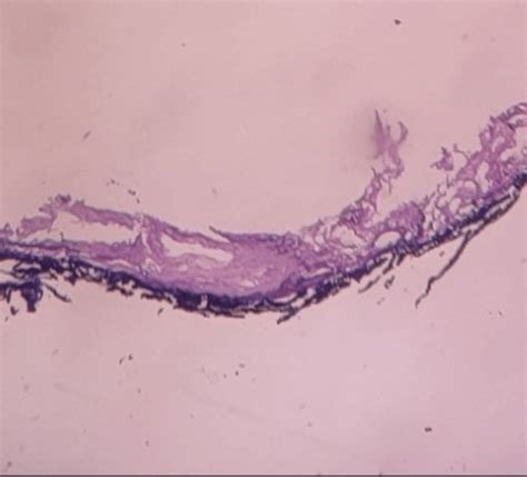 Cureus A Giant Epidermoid Cyst In The Floor Of Mouth Mimicking Ranula
