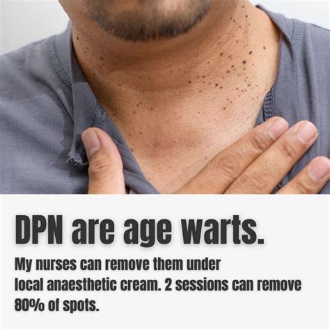 Best Dermatosis Papulosa Nigra Dpn In Brisbane Dr Davin Lim