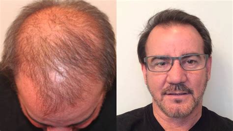 Hair Transplant Patient Of Dr Marc Dauer Youtube
