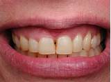 Photos of Silver Crowns Teeth Cost