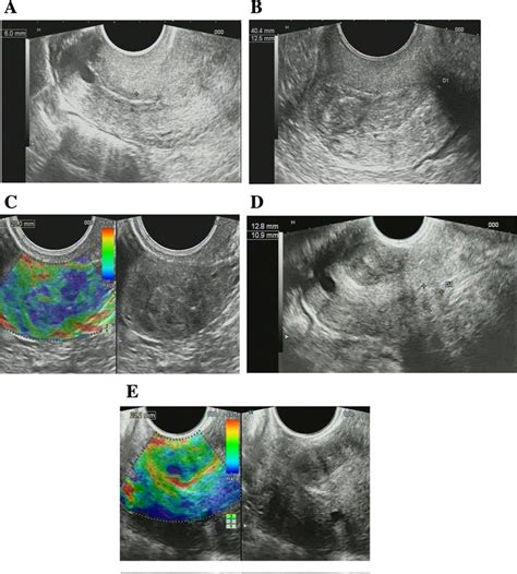 ultrasound of cervix dysplasia sexiz pix