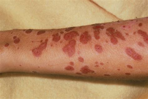 Derm Dx A Painful Red Or Purplish Rash Spreads And Blisters Clinical