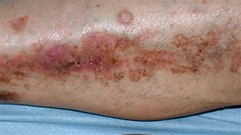 Type 2 Diabetes And Skin Pictures Dermopathy Infections And More