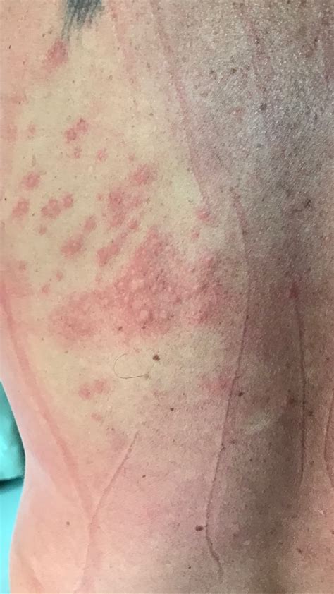 Itchy Rash On My Back Health And Medicine Thailand News Travel