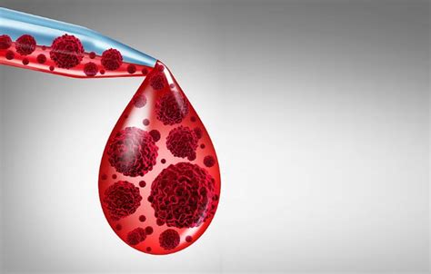 6 ранних признаков рака крови которые нельзя игнорировать Lifter