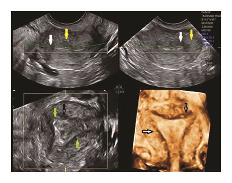 Severe Adenomyosis With Multiple Sonographic Signs Multiplanar And 3d