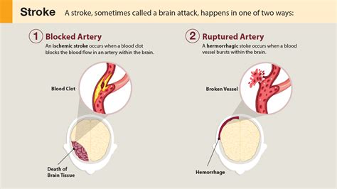 Stroke Also Called Cva Cerebrovascular Accident Medix Urgent Care