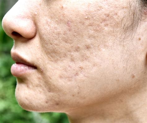 Acne Scars Effective Treatments And Prevention Strategies Freyja Medical