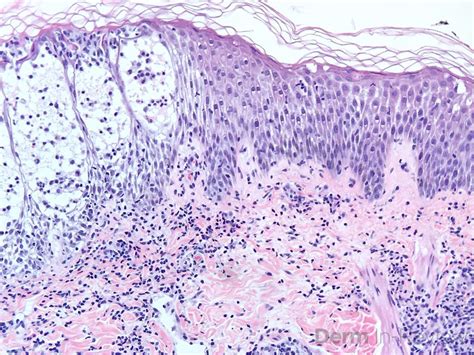 Figure 537 Spongiotic Dermatitis Derm In Review