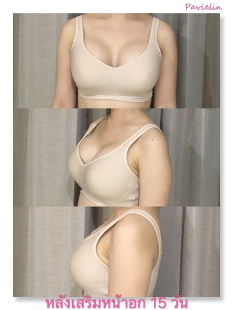 Фото с анатомическими имплантами до и после фото