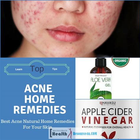 Best Acne Natural Home Remedies For Your Skin Ways To Get Rid Of Acne