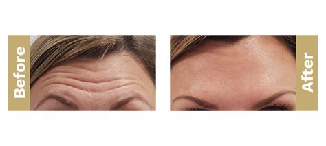 Treatment Of Forehead Lines Dermalogic Aesthetics
