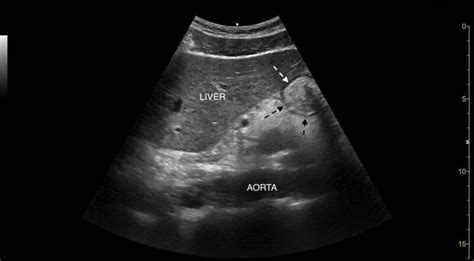 Figure Gastric Ultrasound Image Highlighting Hypoechoic Muscular