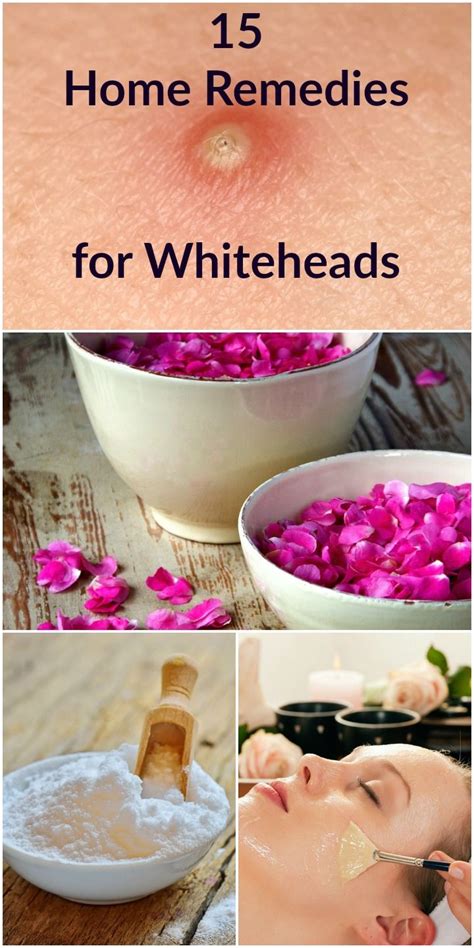 15 Home Remedies For Whiteheads Skin Care Whitehead Removal Skin