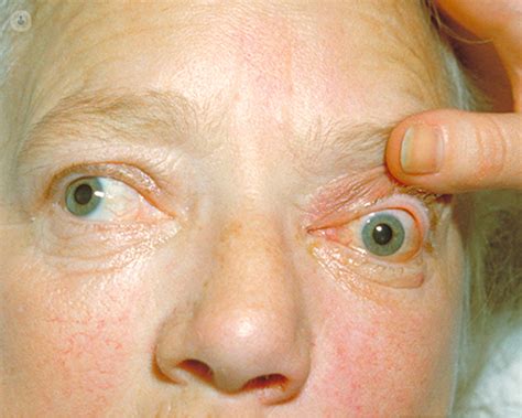 Exophthalmos Bulging Eyes What Is It Symptoms And Treatment Top