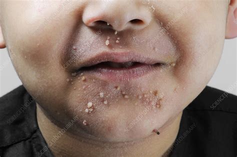 73 Images Of Viral Warts For Free Myweb