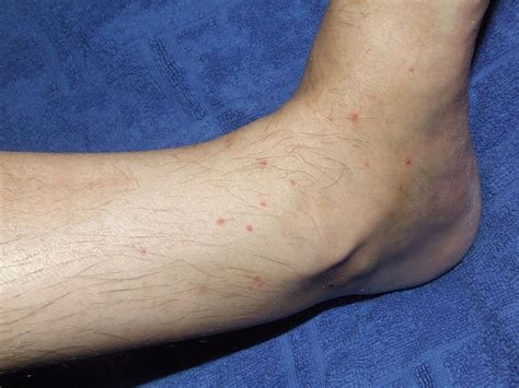 Flea Bites On Humans Symptoms And Treatment Dengarden