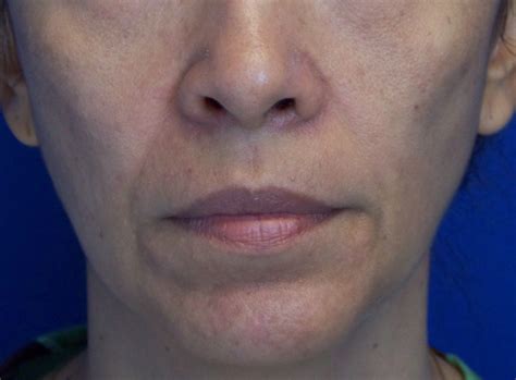 Prefat Injection Nasolabial Folds And Marionette Lines Roxana Cobo