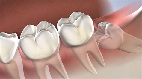 Symptoms That Indicate Wisdom Teeth Removal Procedure