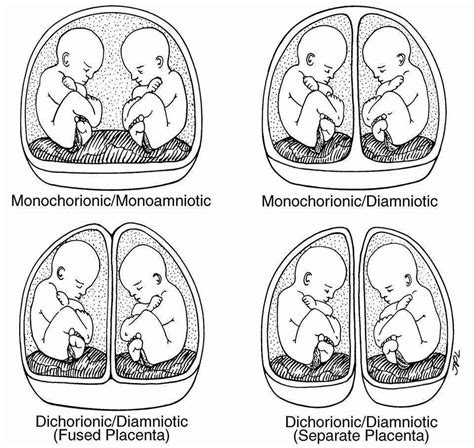 Twinlala Types Of Twins