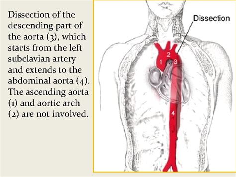 Aortic Dissection Dr M Sofi Md Frcp London