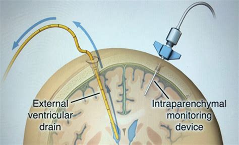 Anatomy Of An External Ventricular Drain Criticalcare