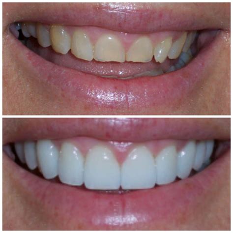Full Smile Makeover Success Dental Veneers Dental Images Perfect Teeth