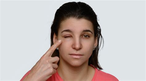 Swollen Eyelids Causes Symptoms And Remedies Healthkart
