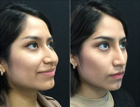Non Surgical Rhinoplasty Before And After Photos Fairfax