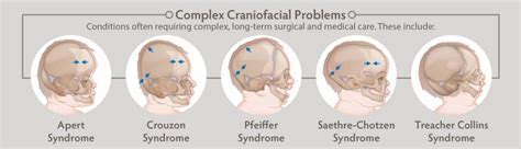 Craniofacial Anomalies And Surgery Pottstown Oral Surgery Blog