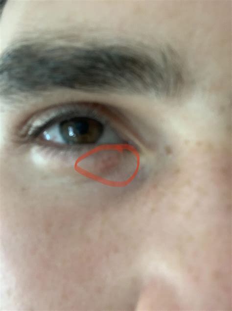 Skin Concern Raised Red Mark Under Eye What Could This Be
