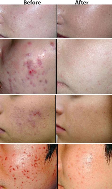 Acne Tips Treatments And Advice With Images Beauty Hacks That