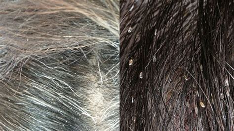 She will have dark, wavy hair, black i love know what my kid/kids will look like but i'm way to young to have kids i'd like to have kids at maybe. How can I tell if I have head lice or dandruff? - YouTube