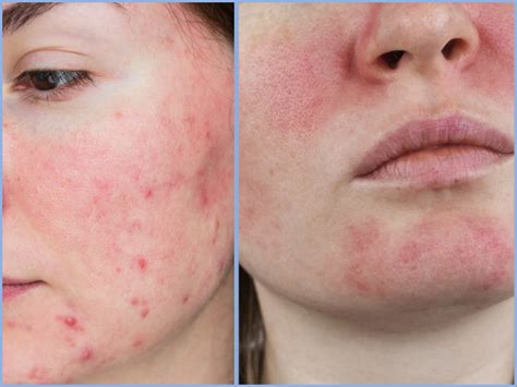 Gp Workshop Acne Rosacea And Maskne Clinical Pearls Skin Health