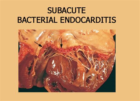Subacute Bacterial Endocarditis Focus Dentistry