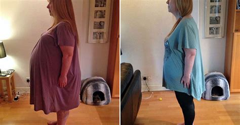 Womans Five Stone Ovarian Cyst Woman Who Thought She Was Pregnant