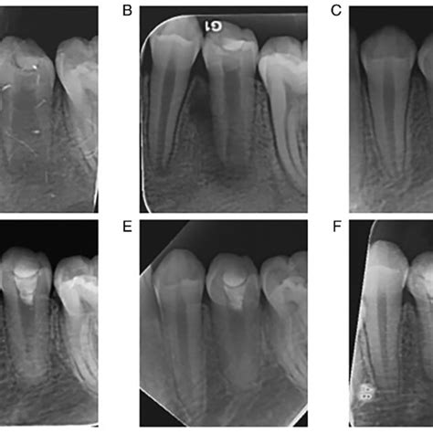 Follow Up Periapical Radiographs Of Tooth 15 A Preoperative