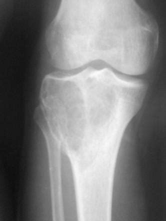 Giant Cell Tumor Of Bone Knee Radiology Case Radiopaedia Org
