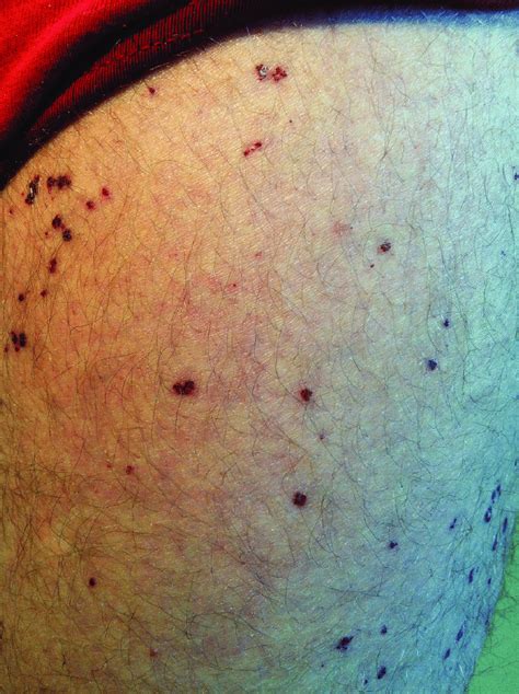 Angiokeratoma On The Patients Thigh After 10 Years Of Enzyme