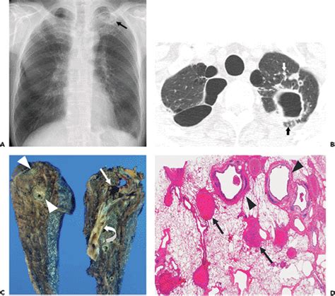 Imaging In Nontuberculous Mycobacterial Lung Infections