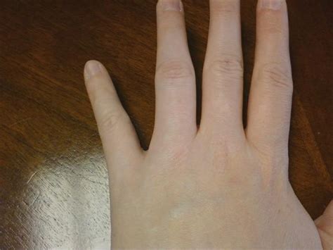 Swollen Finger Joint