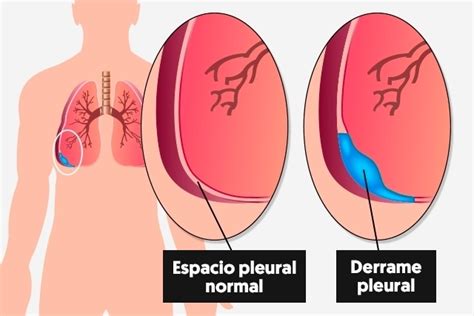 Derrame Pleural Que Es Causas S Ntomas Y Tratamiento Maestria Salud