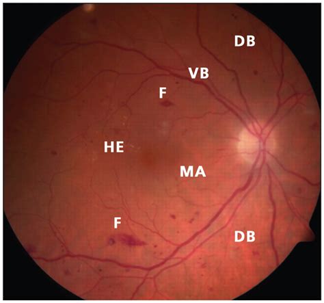Retinal hemorrhages, often first diagnosed in the primary eye care setting, can be a presenting finding in many ocular and systemic disease states. Diabetic retinopathy | CMAJ