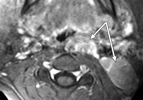 Imaging Of Cervical Lymphadenopathy In Children And Young Adults Ajr