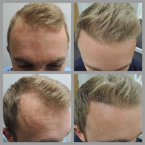 Hair Transplants Before And After