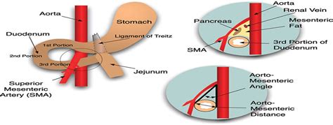 superior mesenteric artery syndrome gastroenterology nursing