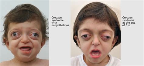 Crouzon Syndrome Pictures